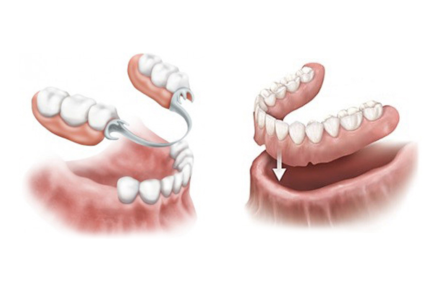 Protesi Fissa e Mobile
